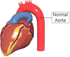 Thoracic Aortic Aneurysm - Newport Cardiac & Thoracic Surgery