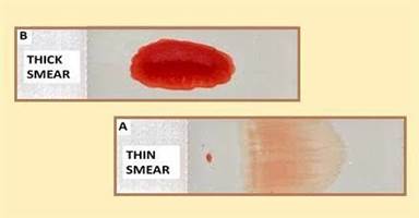 A close-up of a blood smear
Description automatically generated