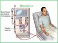 Biology Notes for IGCSE 2014: # 100 Dialysis and its application ...